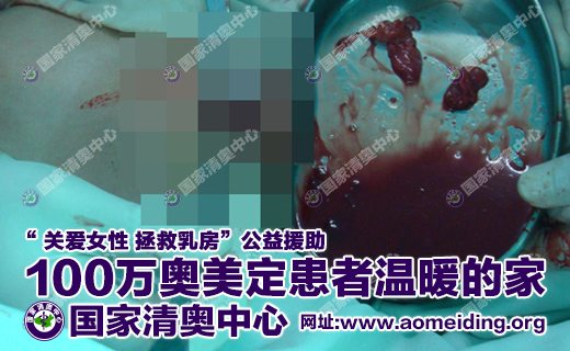  奥美定取出